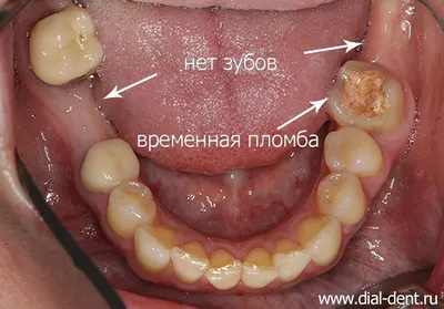 Какие импланты зубов лучше всего подойдут именно вам | Альянс  бьюти-ортопедов, Москва