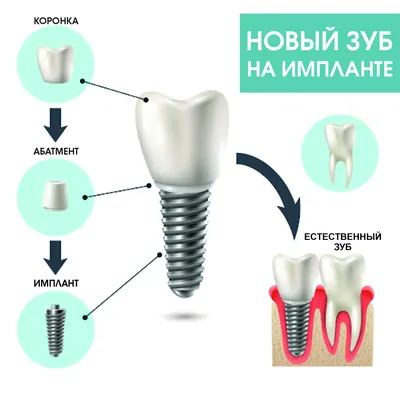 Дентальная имплантология ‹ Стоматологическая клиника Profi-Dent