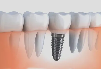 Имплантация зубов недорого - вставить импланты зубов в Москве недорого,  имплант дешево в стоматологии DentBerg