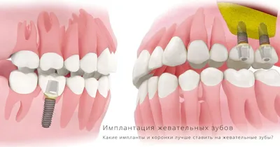 Имплантация зубов сразу после удаления зуба