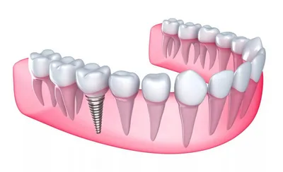 Имплантация зубов цены в Алматы и Астане, Атырау, Усть-Каменогорск,  Уральск, Кокшетау