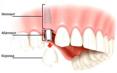Как Ставят Имплант Зуба Вставляют Имплантант ЛюмиДент