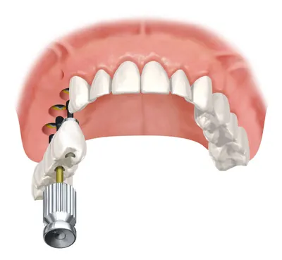 Имплантация жевательных зубов [Какой имплант лучше ставить?]