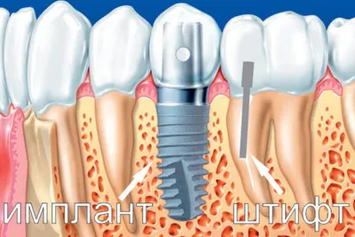 Недорогая имплантация зубов в г. Челябинск с максимальной гарантией
