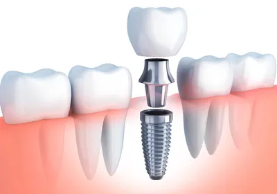 Как устанавливают зубные импланты? — Ответы на вопросы врачей  стоматологической клиники Миллидент в Казани