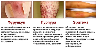 Инфекционная сыпь фото