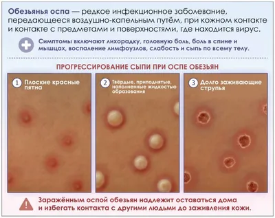 Экзантема - причины появления, симптомы заболевания, диагностика и способы  лечения