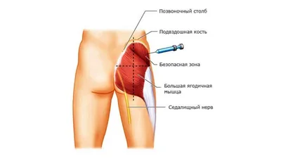 Учреждение здравоохранения \"Щучинская центральная районная больница\" -  Профилактика постинъекционных нагноений или вред самолечения