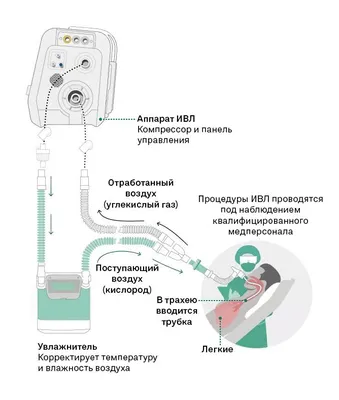 Заново учиться дышать, глотать и ходить: как меняется жизнь после искусственной  вентиляции легких | Forbes.ru