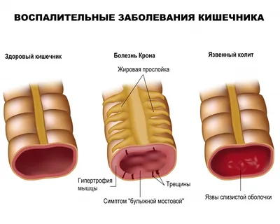 Кровь в стуле - причины появления, при каких заболеваниях возникает,  диагностика и способы лечения