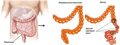 Рак кишечника симптомы, первые признаки у женщин и мужчин