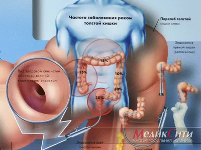 Рак кишечника: симптомы, причины. диагностика и лечение рака кишечника