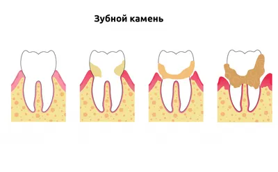 Что такое зубной камень? Виды лечения зубного камня, профилактика