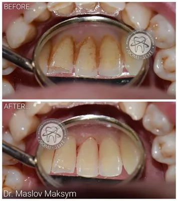 Зубной камень: причины, виды, лечение