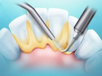 Удаление зубного камня | Цены на удаление зубного камня ультразвуком,  лазером в «СМ-Стоматология» во Владимире