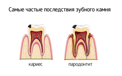 Зубной камень: причины образования и методы удаления | Стоматологическая  клиника \"Лучший\" в Брянске