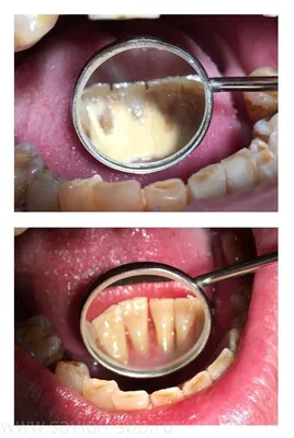 Зубной камень: причины, лечение, профилактика | Как избавиться от зубного  камня