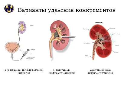 Камни в почках бывают разные - Ортодонтическая клиника \"Альтер Эго\". Спб.