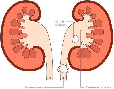 Камни в почках (нефролитиаз) - симптомы, причины, лечение, признаки