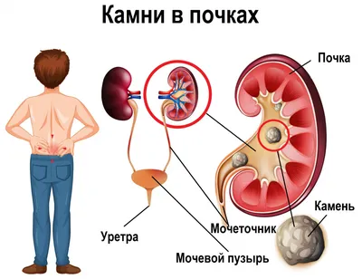 Камни в почках - причины появления, при каких заболеваниях возникает,  диагностика и способы лечения