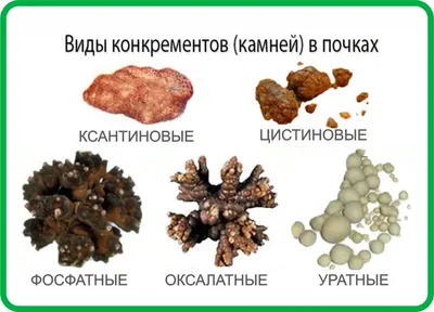 Камни в почках у детей - лечение в Москве бесплатно по полису ОМС