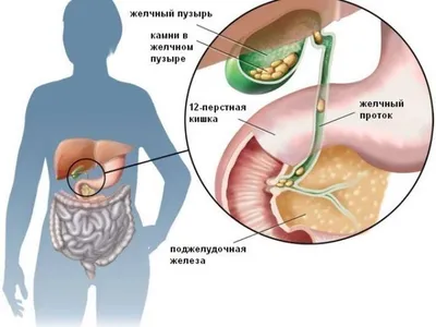 В чем опасность камней в желчном пузыре? | Блог Авиценна Медикал