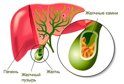 Камни из желчного пузыря | Пикабу