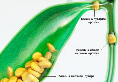 Камни в желчном пузыре: виды, симптомы и лечение - АКАДЕМФАРМ