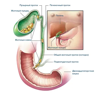 Камни в желчном пузыре - симптомы обострения, лечение - 2023