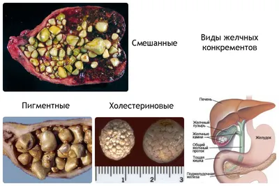 Камни в желчном пузыре, как лечить