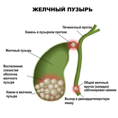 Аюрведическое лечение камня желчного пузыря: препараты и рекомендации