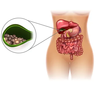 Желчнокаменная болезнь - симптомы и причины ЖКБ, диагностика и лечение