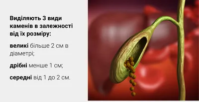 Лечение камней в желчном пузыре без операции, препараты для растворения.