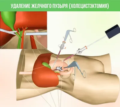 Удаление камней из желчного пузыря с сохранением | ВКонтакте