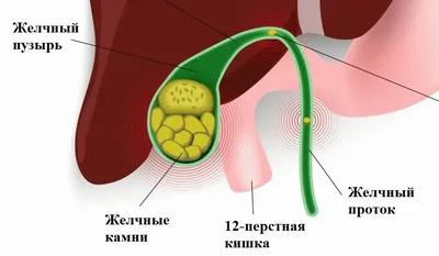 Камни в желчном пузыре - причины, симптомы, лечение, операция,  лапароскопия. - Хирург К. В. Пучков