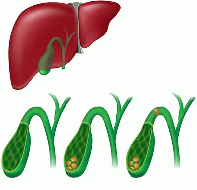 Камни в желчном пузыре: виды, симптомы и лечение - АКАДЕМФАРМ