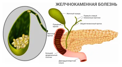 Хирурги Башкирии вырезали желчный пузырь с камнем с куриное яйцо - Время  России (news)