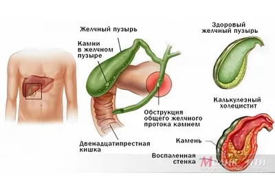 Операция по удалению желчного пузыря методом лапароскопии: удаление камней  из желчного