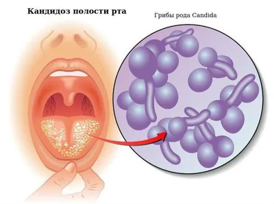 Орофарингеальный кандидоз лечение консультация в клинике ID-CLINIC  Санкт-Петербург