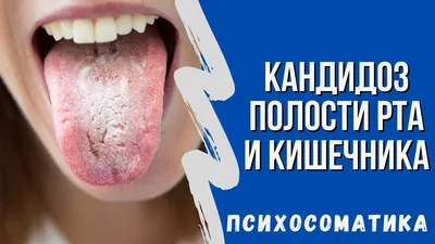 ВИЧ-инфекция: проявления в области рта при СПИДеDENTALMAGAZINE.RU