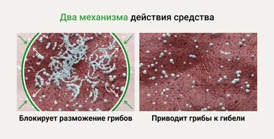 Урогенитальный кандидоз. Клинические рекомендации.