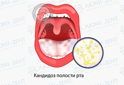 Кандидоз полости рта. - Терапия - Стоматология для всех