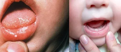 Что такое заеды в уголках рта и почему они возникают?