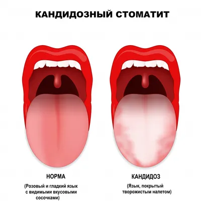 Заеда (щелевидное импетиго) — Derma.ua