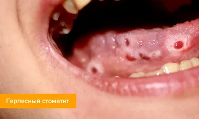 история болезни кандидозный хейлит стоматология ангулярный | Monografías,  Ensayos Детская стоматология | Docsity