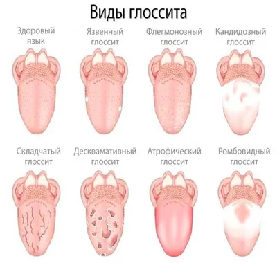 Ромбовидный глоссит. Новости и публикации НоваДент | НоваДент