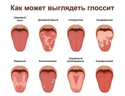 Глоссит 【Причины, симптомы, диагностика и лечение】