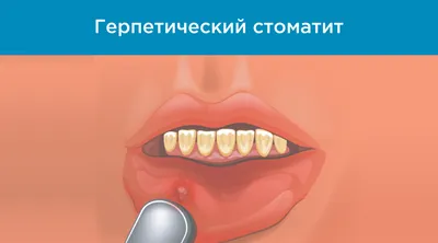 Стоматит у ребенка - как и чем лечить | Блог Daily Medical