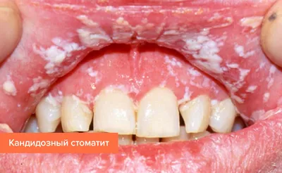 Стоматит в детском возрасте | NeoLifeDental