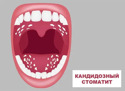 ВИЧ-инфекция: проявления в области рта при СПИДеDENTALMAGAZINE.RU